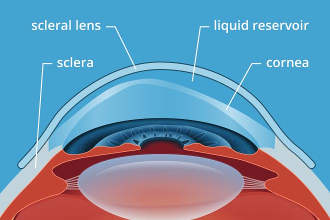 Fully Customized Mini-Scleral Lenses (For Pathological Corneas)