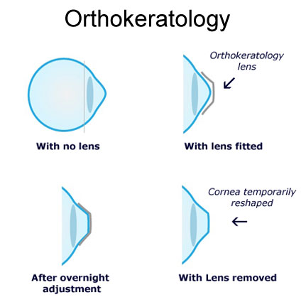 Fully Customized Orthokeratology (Ortho-K) Treatment (For Adults Undergone Refractive Surgery)