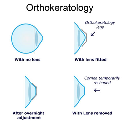 https://storage.keepital.com/public/company/sg/a/e/aerov-pte-ltd/images/product/fully-customized-orthokeratology-ortho-k-treatment-for-children/wMu9zH38PLo3GkXFi.jpg